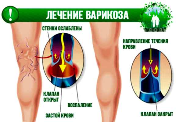 лечение варикоза на ногах