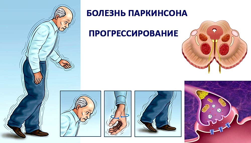 прогрессирование болезни Паркинсона