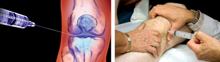 реабилитация при артрозе