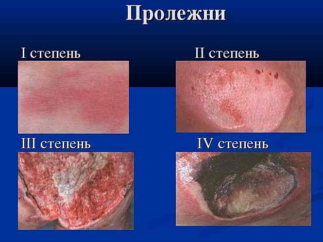 стадии пролежней